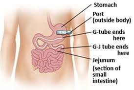 Gastrostomy Care Nurses